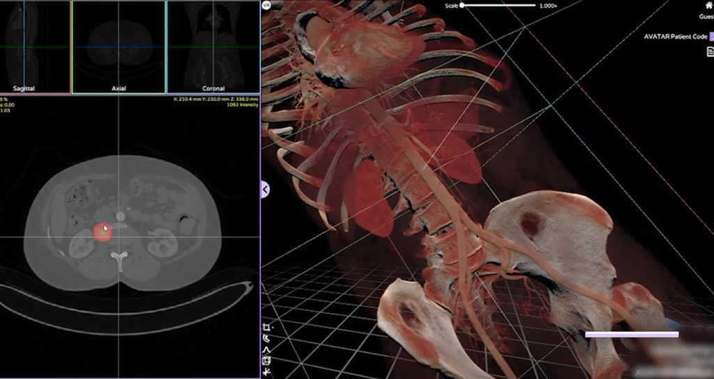 Medical imaging workstation: sagittal, axial and coronal reference views on the left with a marked structure, and a real-time three-dimensional reconstruction of the ribcage, spine, vessels and pelvis on the right